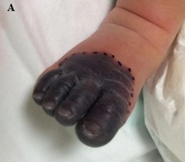 Тяжёлая врождённая недостаточность протеина C