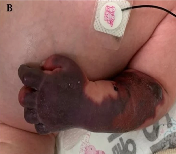 Тяжёлая врождённая недостаточность протеина C