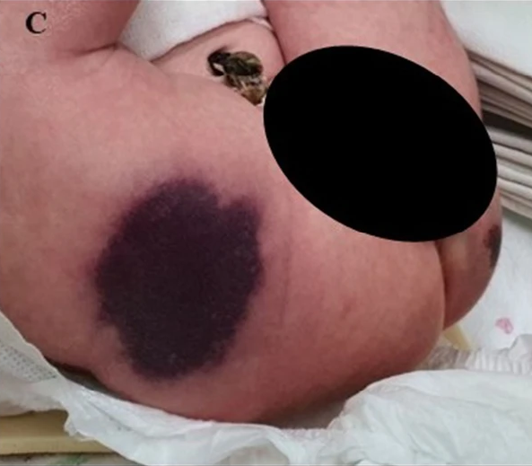 Тяжёлая врождённая недостаточность протеина C