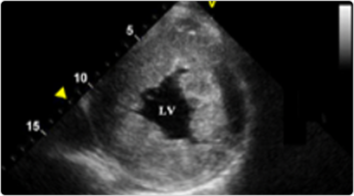Фабри ауруы кезіндегі сол жақ қарыншаның эхокардиографиясы