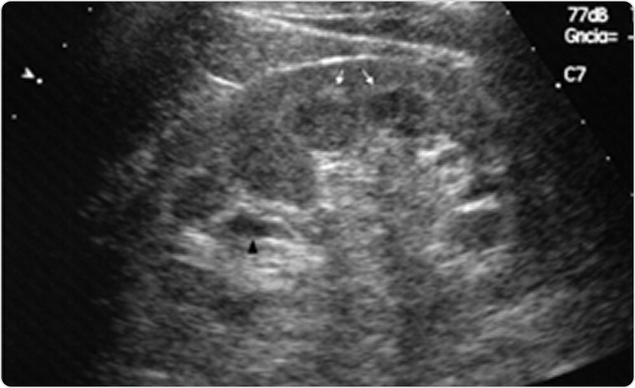 Фабри ауруы кезіндегі бүйректің ультрадыбыстық кескіні