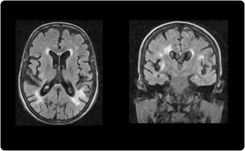 Фабри ауруы кезіндегі өзгерістері бар ми МРТ-сі