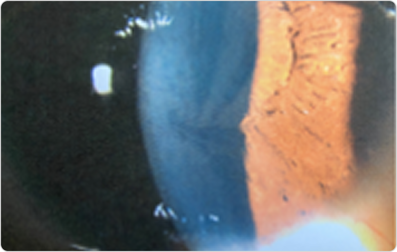 Фабри ауруы кезіндегі cornea verticillata бар қасаң қабықтың фотосуреті