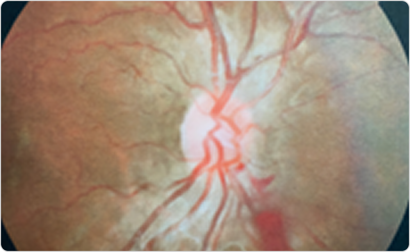 Фабри ауруы кезіндегі тамырлық өзгерістері бар көз түбінің фотосуреті