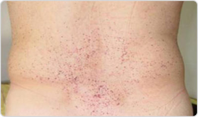 Көптік ангиокератомалар