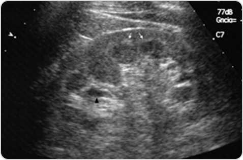 Фабри ауруы кезіндегі бүйректің ультрадыбыстық кескіні