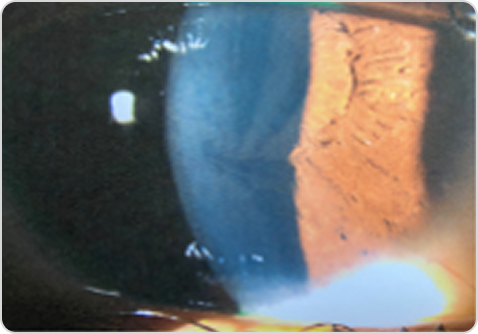 Фабри ауруы кезіндегі cornea verticillata бар қасаң қабықтың фотосуреті