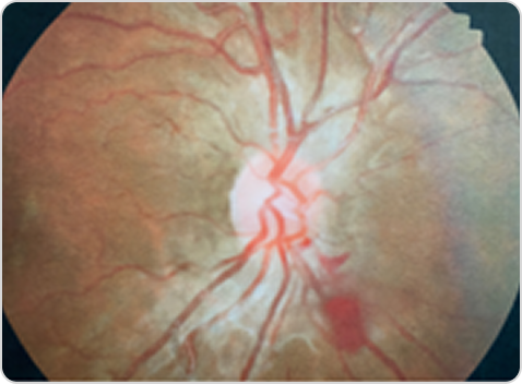 Фабри ауруы кезіндегі тамырлық өзгерістері бар көз түбінің фотосуреті