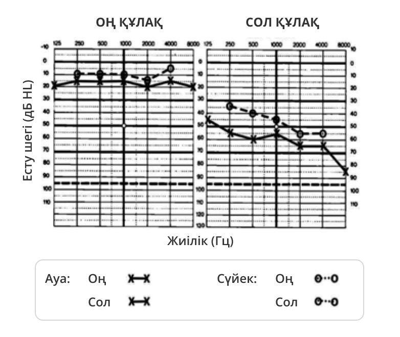 Кохлеовестибулярлық бұзылыстар кезіндегі тоналдық шектік аудиограмма